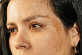 Pele com melasma: o que fazer e o que evitar no verão